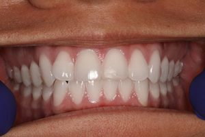Virtual Consultation Front Teeth