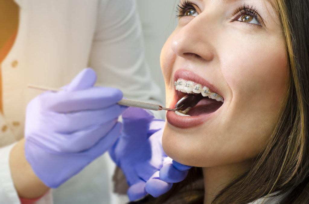 What Is an Underbite and How Do You Go About Fixing It? Vincent Team