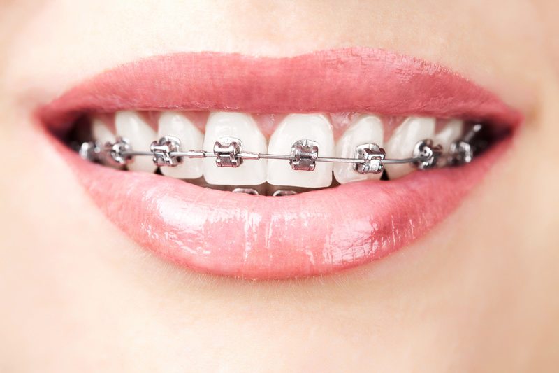 getting braces as an adult