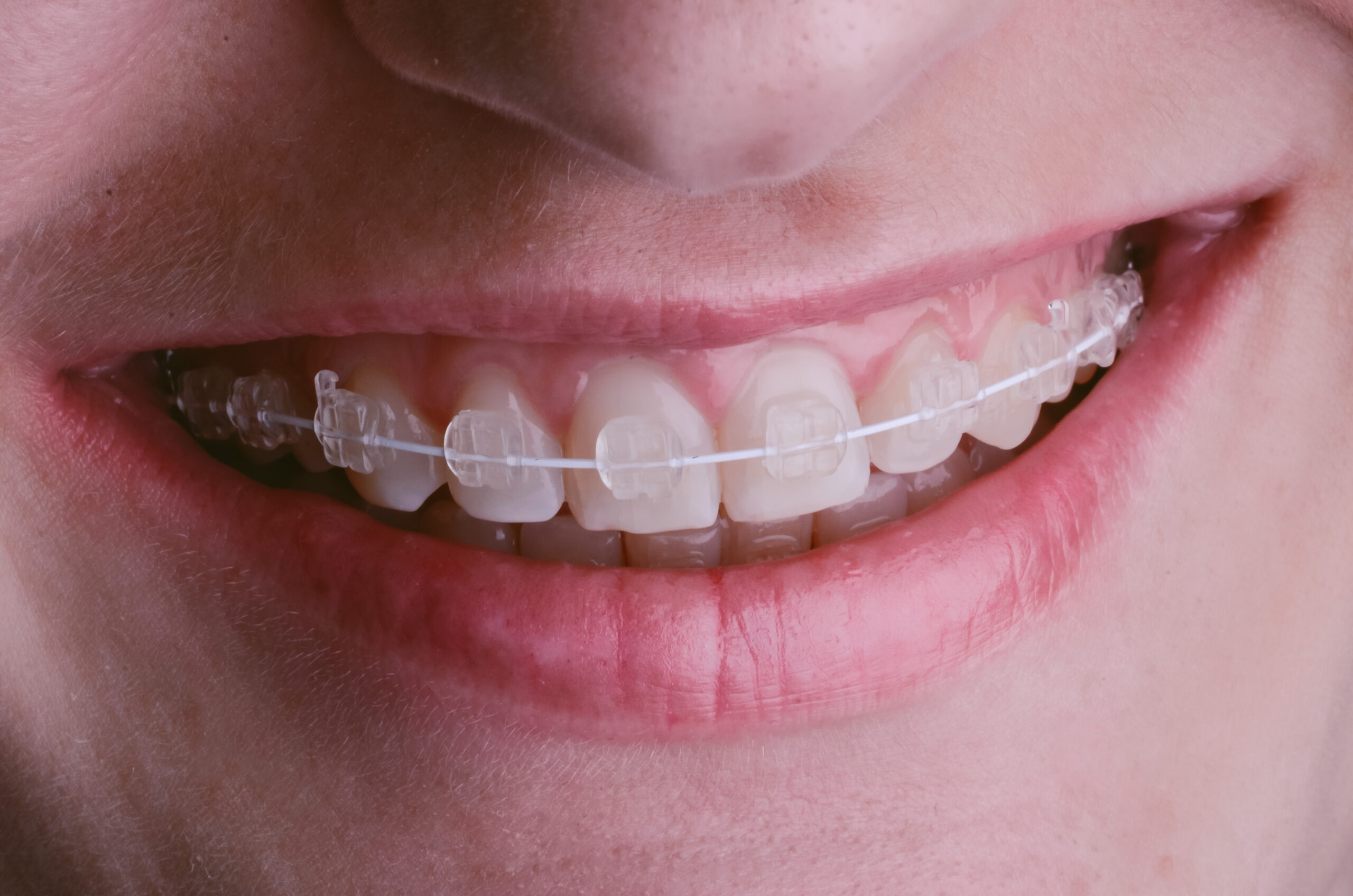 Advance Metal Braces Vs Ceramic Clear Braces